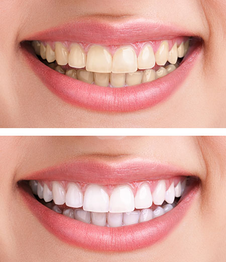 Before after teeth whitening