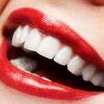 Porcelain Teeth Crowns at Kind Smiles Dental Health in Lakewood Ranch FL Area