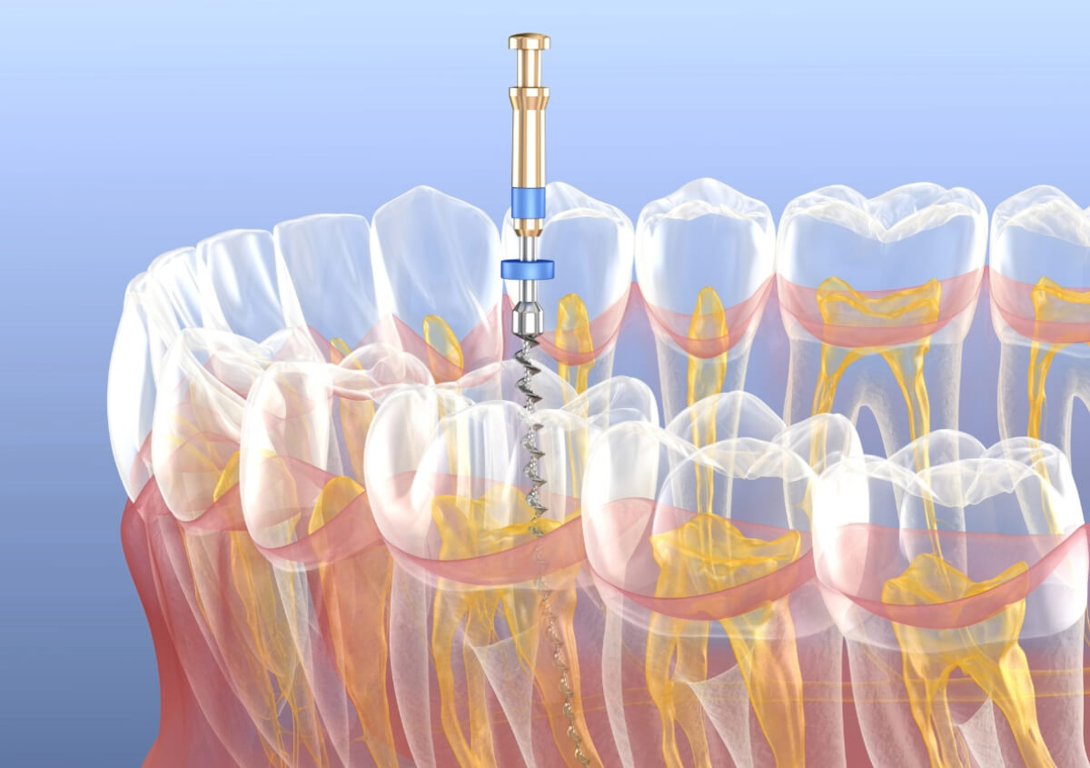 Dentist That Do Root Canals in Lakewood Ranch FL area